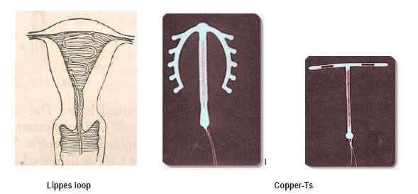 Lippes Loop: The Lippes loop consists of a thin plastic (or polyethylene)wire bent in a series